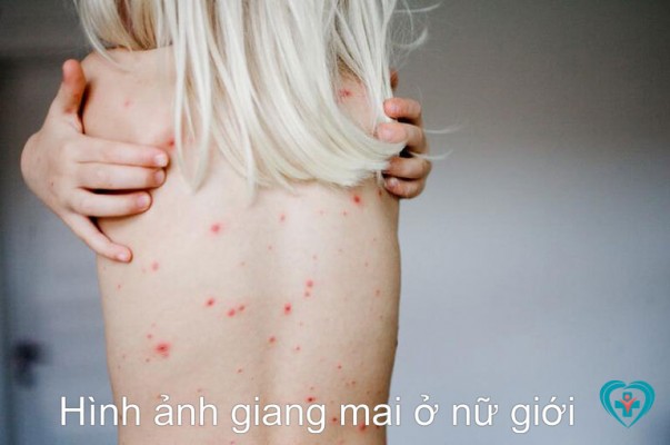 Bệnh giang mai ở nữ giới