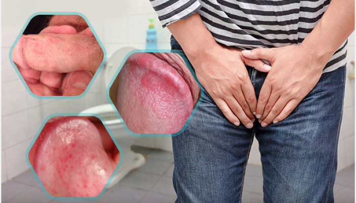 Không quan hệ tình dục có thể mắc bệnh sùi mào gà không?