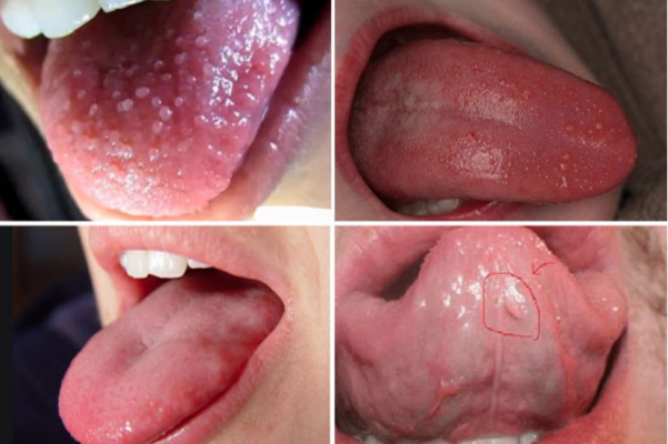 Phân biệt nhiệt miệng với bệnh sùi mào gà ở miệng