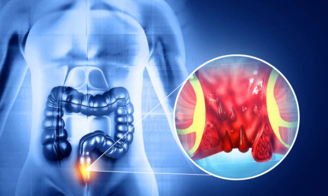 Bệnh trĩ nên ăn gì và kiêng ăn gì tốt cho sức khỏe?