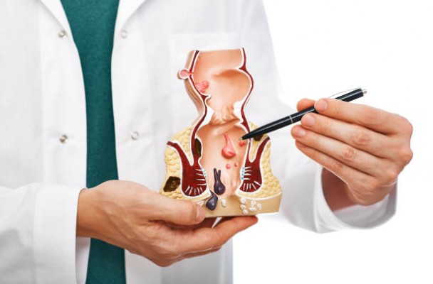 4 cách chữa bệnh trĩ ngoại đơn giản hiệu quả