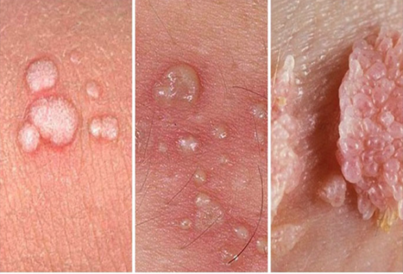 Bệnh sùi mào gà âm đạo: Nguyên nhân, dấu hiệu, hình ảnh, cách chữa