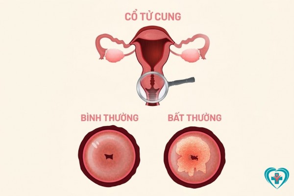Viêm lộ tuyến cổ tử cung có mang thai được không? ảnh hưởng gì