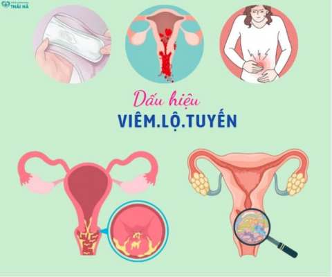 Viêm lộ tuyến cổ tử cung độ 3: Dấu hiệu và cách điều trị