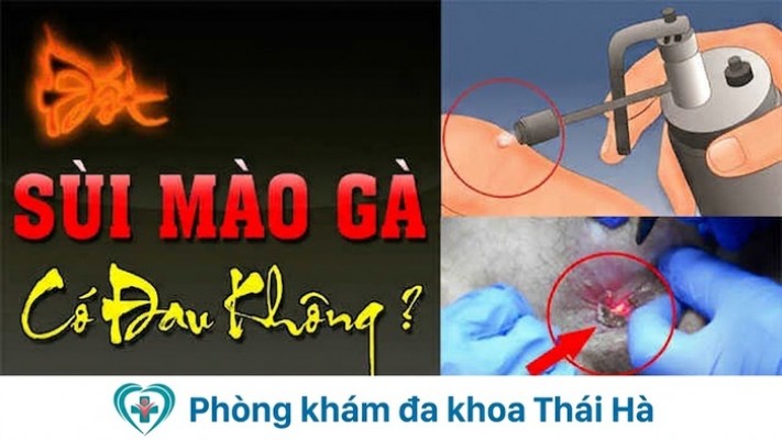đốt sùi mào gà có đau không