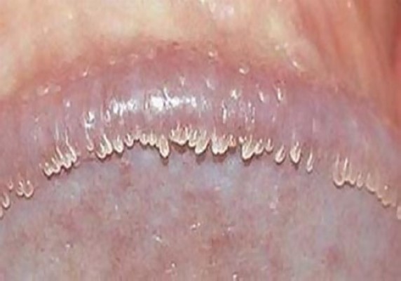 Gai sinh dục là gì? Có nguy hiểm không? Cách điều trị