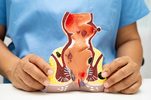 Hình ảnh bệnh trĩ nội, trĩ ngoại, trĩ hỗn hợp qua các giai đoạn
