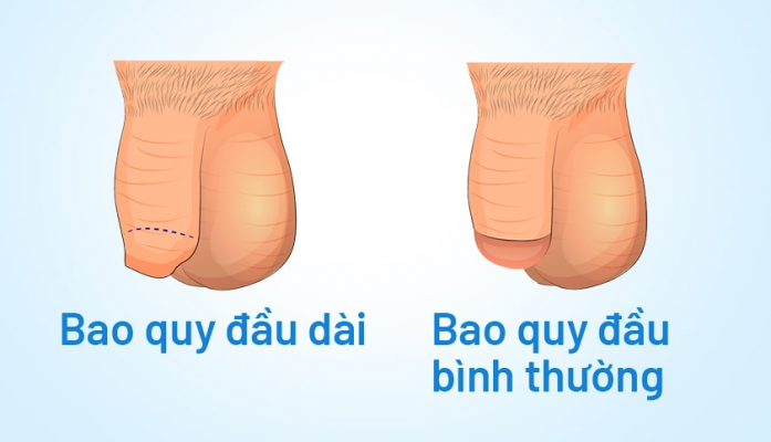 Hình ảnh bao quy đầu bình thường và bất thường ở người lớn