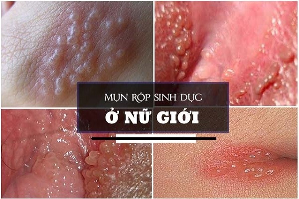 hình ảnh nổi mụn ở vùng kín nữ giới