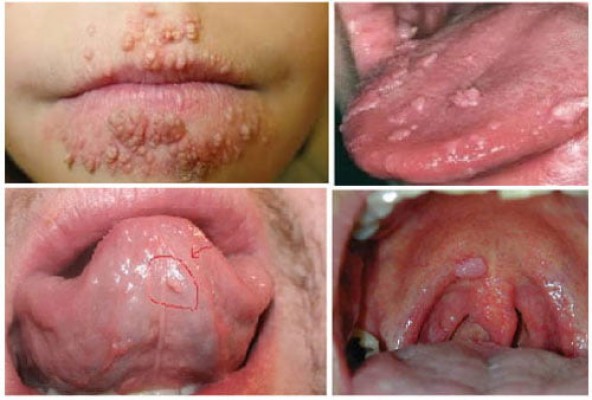 bệnh sùi mào gà ở miệng