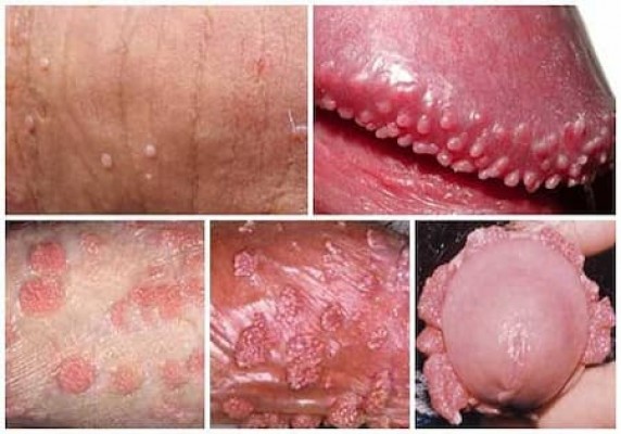 Bệnh sùi mào gà ở hậu môn: Nguyên nhân, dấu hiệu, cách chữa