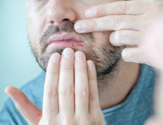 Virus HSV là gì? Nên xét nghiệm HSV ở đâu Hà Nội