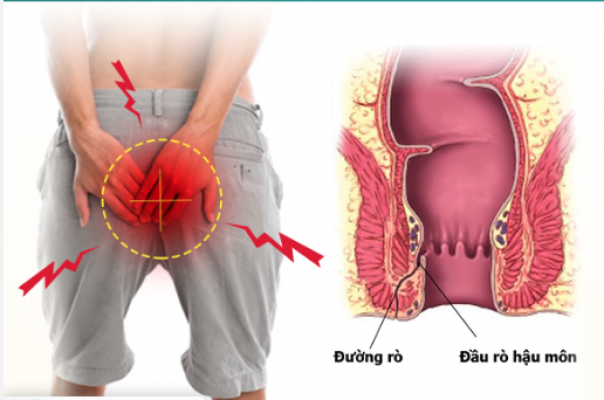 9 địa chỉ khám chữa bệnh rò hậu môn ở đâu tốt nhất Hà Nội