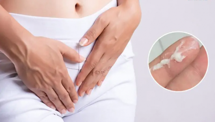 Vùng kín có mảng bám màu trắng là dấu hiệu bệnh gì?