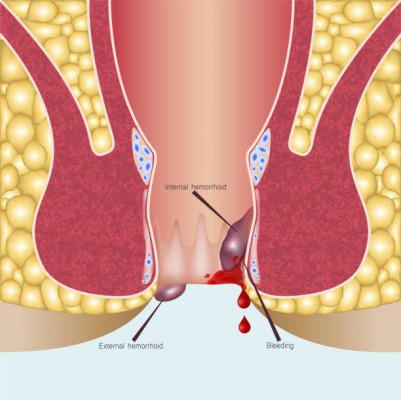 Những biến chứng khôn lường của bệnh rò hậu môn