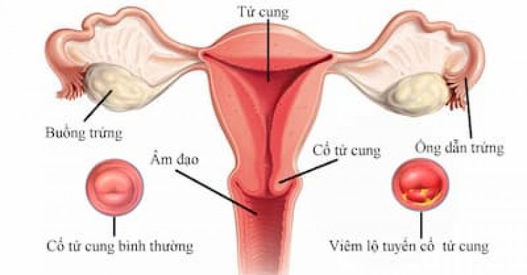 Hình ảnh viêm lộ tuyến cổ tử cung qua từng cấp độ