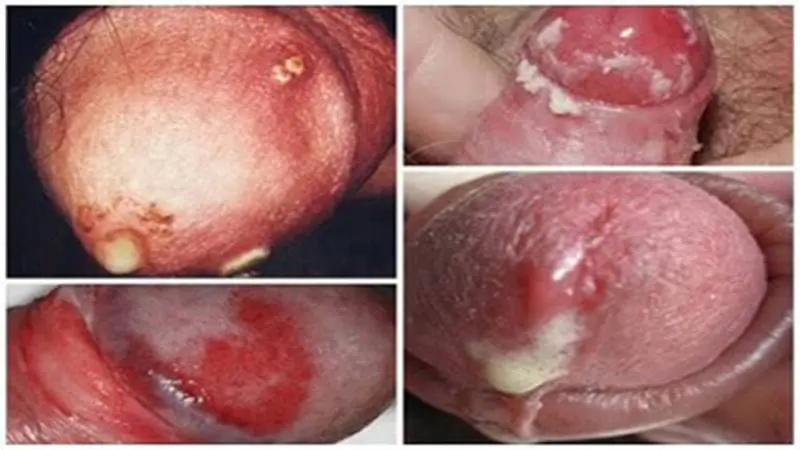 dấu hiệu bệnh lậu ở nam giới