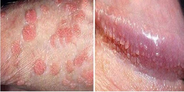 benh-sui-mao-ga-o-hau-mon