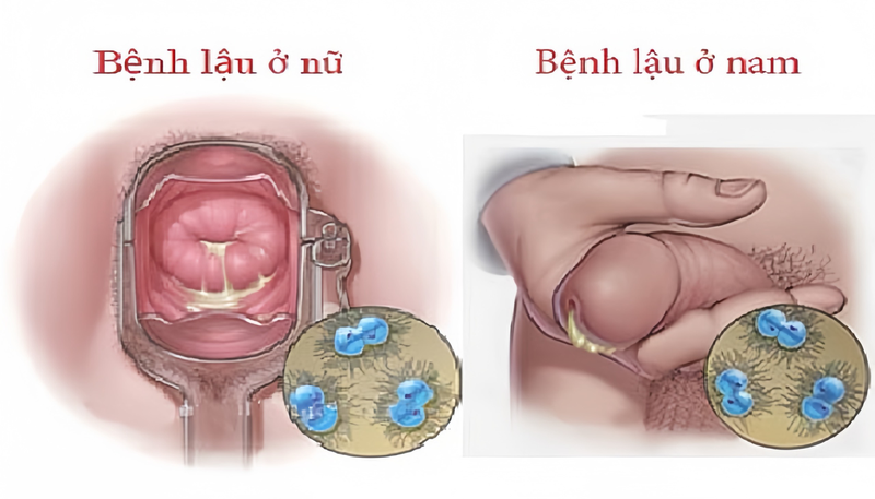 hình ảnh bệnh lậu ở nam giới