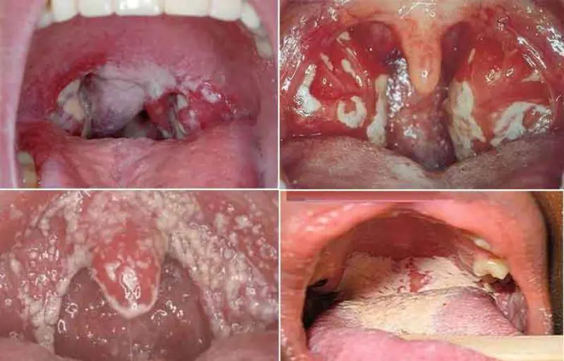 Hình ảnh bệnh lậu trong miệng
