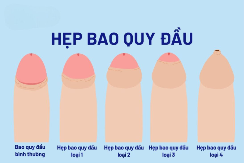 hẹp bao quy đầu