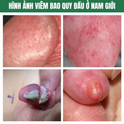 viêm bao quy đầu