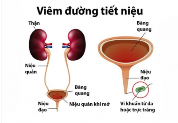 viem-duong-tiet-nieu